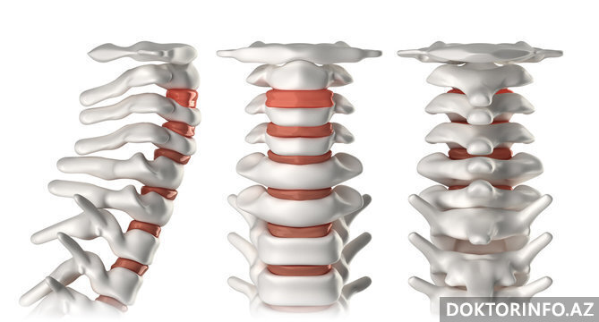 Servikal Vertebra xəstəlikləri nələrdir?