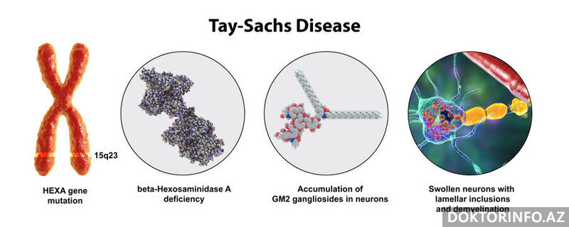 Tay-Sachs xəstəliyi