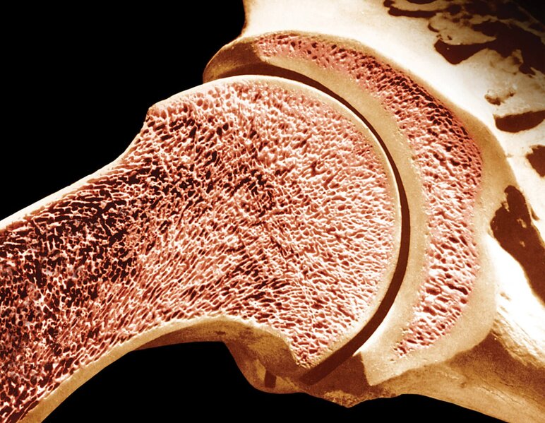 Sümük iltihabı, osteomielit nədir?