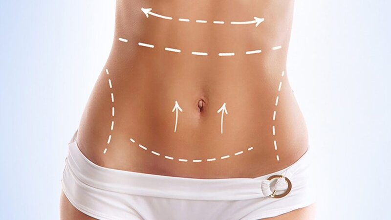 Qarın gərmə, Abdominoplastika əməliyyatı