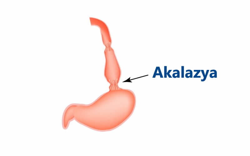 Udma çətinliyi, "Akalazya" problemi nədir?