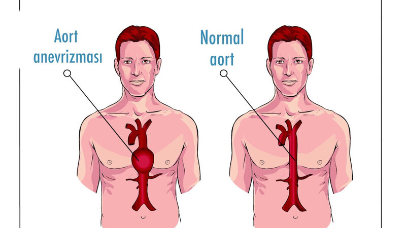 Aorta damarı yırtılması nədir?