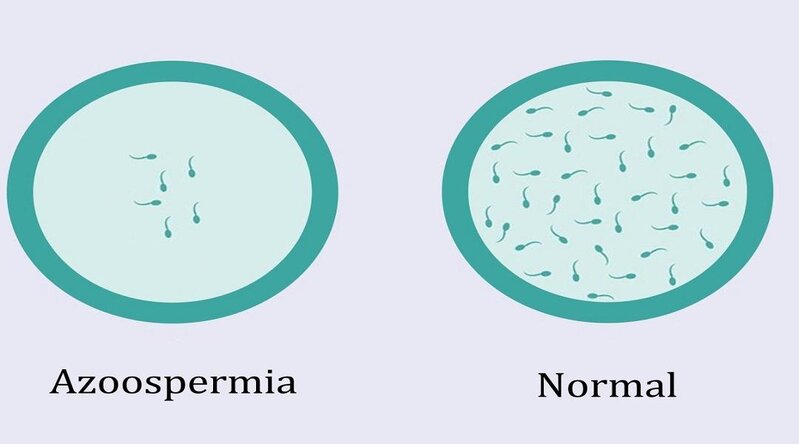 Spermanın olmaması, Azospermiya nədir?