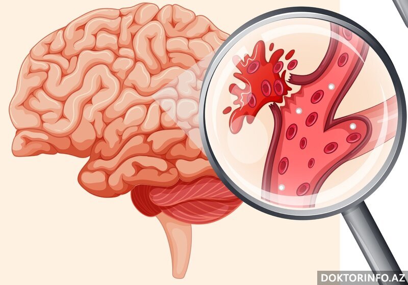 Beyin qanaxması əməliyyatının riskləri