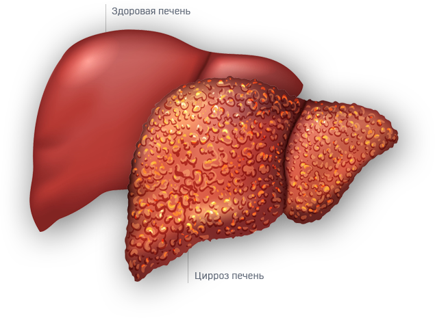 Sirrozun simptomları və müalicəsi