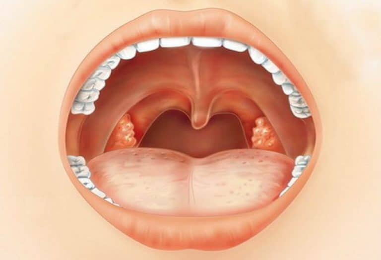 Angina müalicəsi