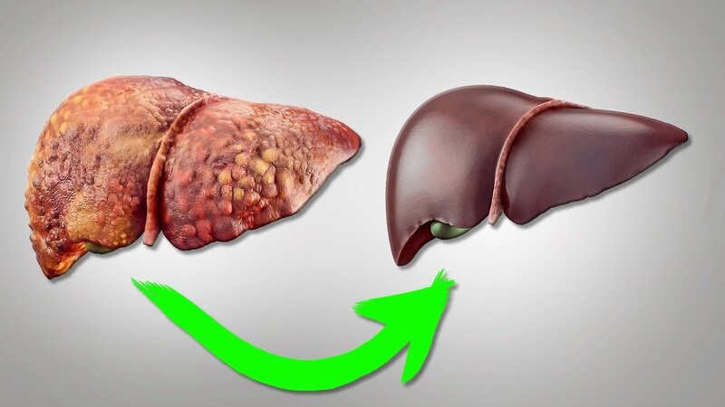 Sirrozun simptomları və müalicəsi