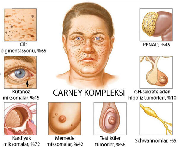 Dəri xal şişləri, Carney kompleksi nədir?