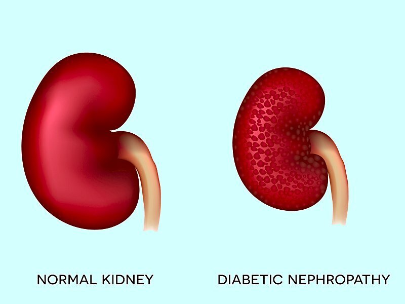 Diabetik nefropatiya nədir?