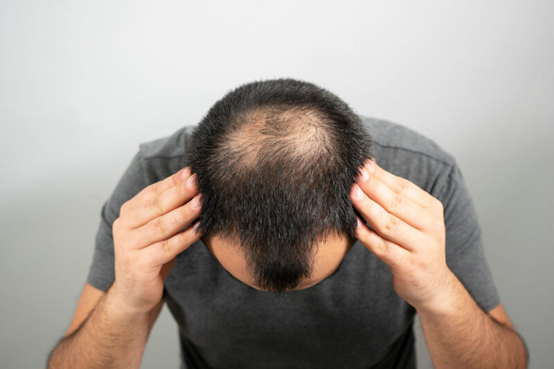 Alopesi areata (Ocaqlı dazlıq) nədir?