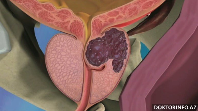 Prostat xərçəngindən necə qorunmalı?