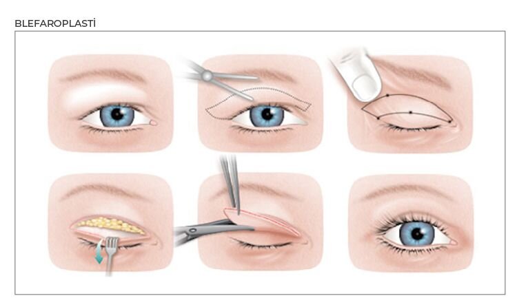 Blefaroplastika əməliyyatı