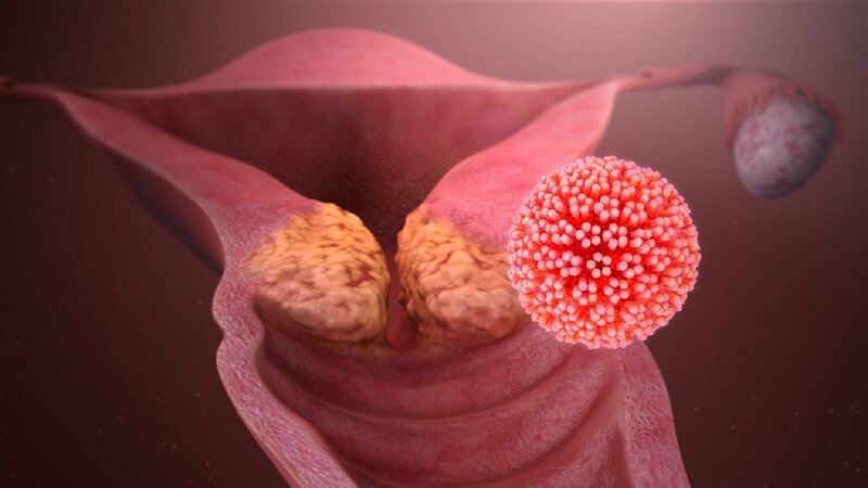 Papillomanın təbii yolla müalicəsi mümkündür?