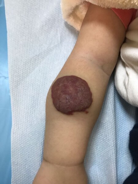 Hemangioma nədir?