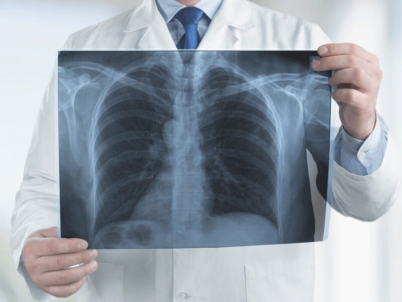 Ağciyər ödəmi (pulmoner ödəm) nədir?