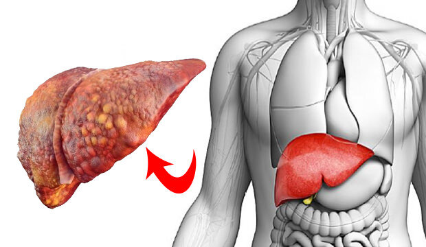 Qaraciyər yağlanması nədir? – Təbii üsullarla çarəsi