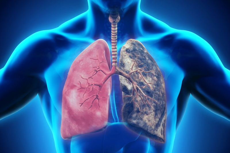 Ağciyər ödəmi (pulmoner ödəm) nədir?