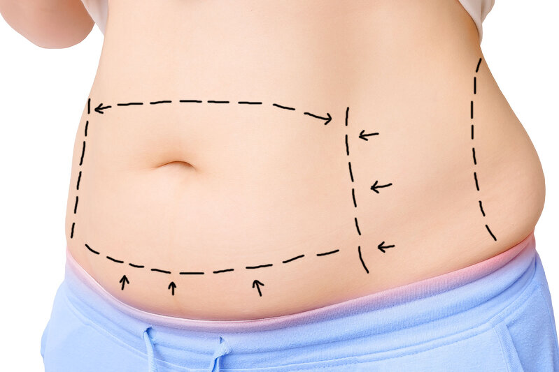 Qarın gərmə, Abdominoplastika əməliyyatı