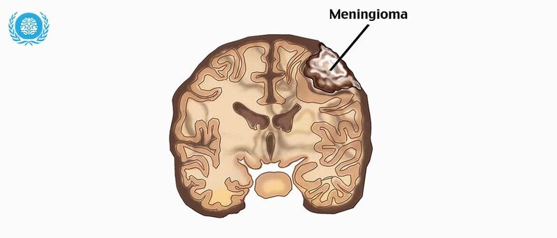 Meningioma xəstəliyi