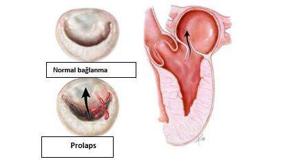 Mitral qapaq qüsuru nədir?