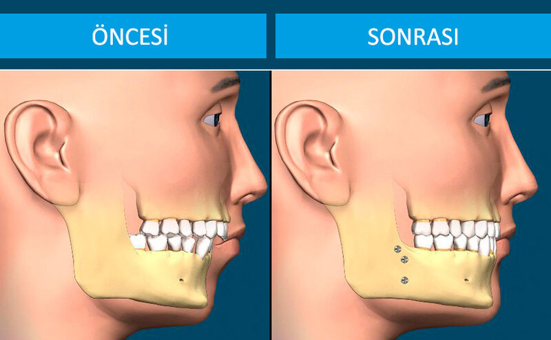 Çənə oynağı problemi nədir?