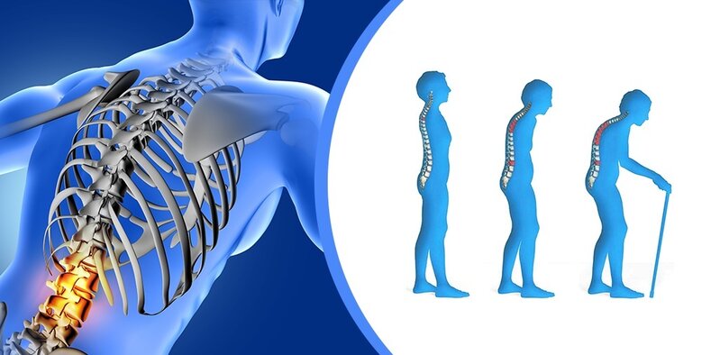 Osteoporoz nədir?