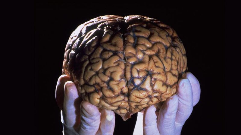 Dumanlı beyin sindromu xəstəlikdir?