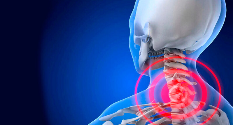 Baş gicəllənməsi, boyunda ağrı - Üst Servikal Onurğa Sindromu nədir?