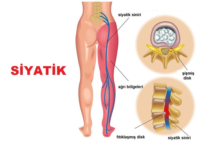 Bir çoxlarının problemi olan siyatik ağrı nədir?