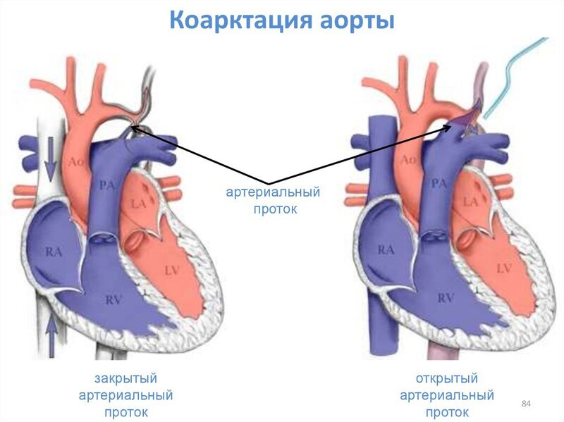 Aorta koarktasiyası nədir?